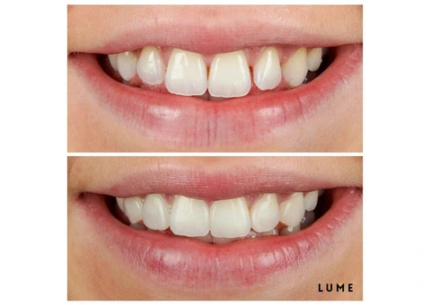 LUME DENTAL - 4/16