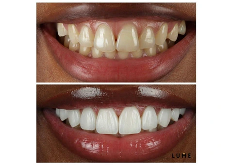 LUME DENTAL - 8/16