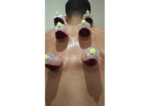 Hijama Cupping Training Course in UK