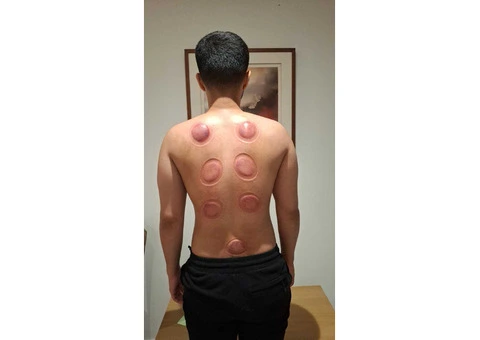 Hijama Cupping Training Course in UK - 2/2