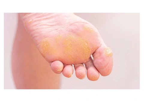 Say Goodbye to the Painful Callus On Your Foot! - 2/2