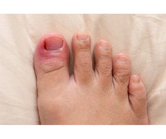 Care for Diabetic Toenails Today!