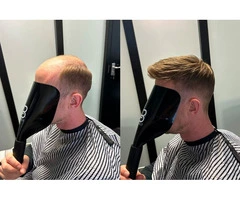 Hair Loss Treatment in Milton Keynes