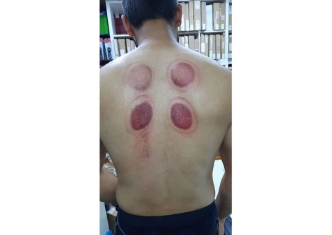 ???? Unveil the Ancient Art of Healing! Join Our Hijama Cupping Therapy Training Course ???? - 1/3