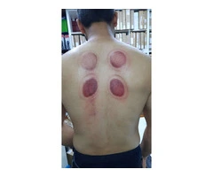 ???? Unveil the Ancient Art of Healing! Join Our Hijama Cupping Therapy Training Course ????