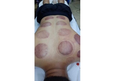 Where to Take Cupping Course in London and How to Enrol? - 2/3