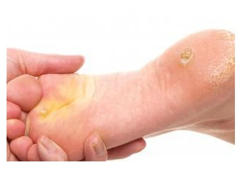 Relief for Painful Calluses on Feet - 2/2