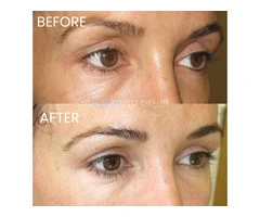 Upper Eyelid Filler in London