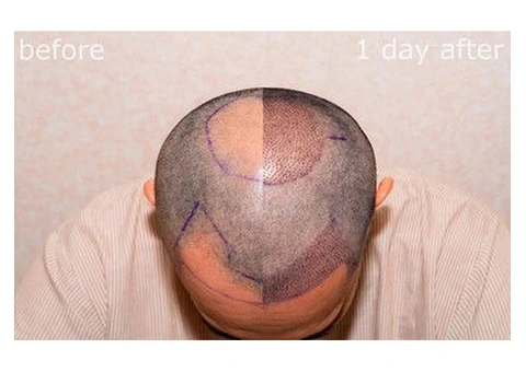 Get the Best Hair Transplant in Turkey Today!