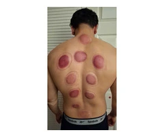 Foundations of Hijama Cupping: A Practical Training Course