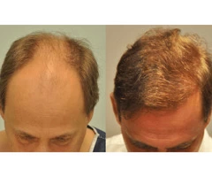 Are you looking for hair transplant options?