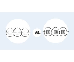 Braces Vs. Invisalign: What's the Difference and Which One Is Better?
