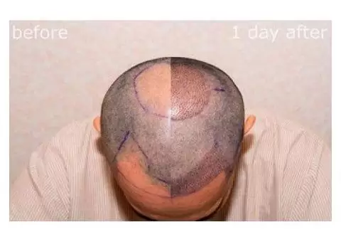 Get the Best Hair Transplant in the UK with Want Hair!
