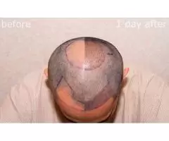 Get the Best Hair Transplant in the UK with Want Hair!