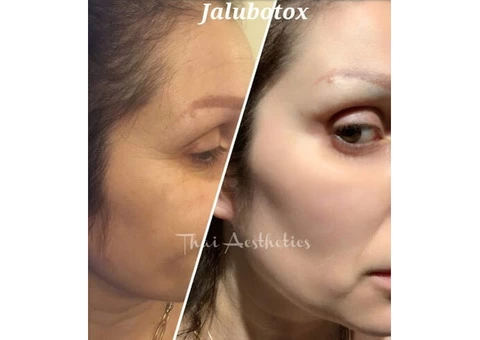 Looking for The Best Threadlift in Peterborough