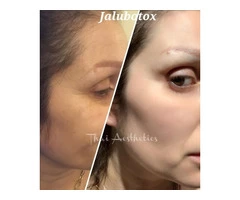 Looking for The Best Threadlift in Peterborough