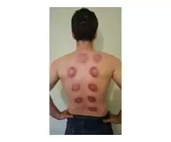 The Complete Hijama Cupping Practitioner Course