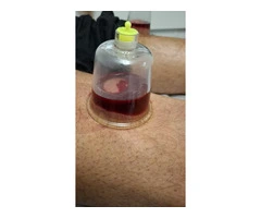The Science and Practice of Hijama Cupping