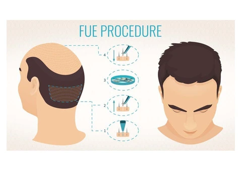 Struggling with Hair Loss? Discover the Best Hair Transplant in the UK!