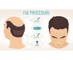 Struggling with Hair Loss? Discover the Best Hair Transplant in the UK!