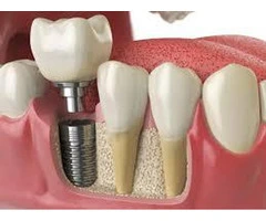 Affordable Dental Implants in London – Book Your Consultation