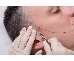 Get a Fuller Beard Today – Book Your Beard Transplant in the UK!