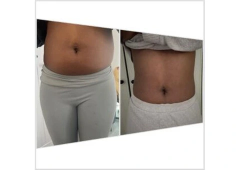 Non-Surgical Fat Reduction in Bromley: A Safe and Effective Solution