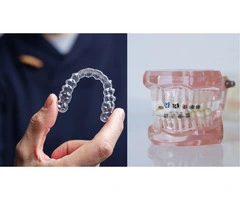Affordable Invisalign Price in the UK: Straighten Your Smile with Clear Aligners