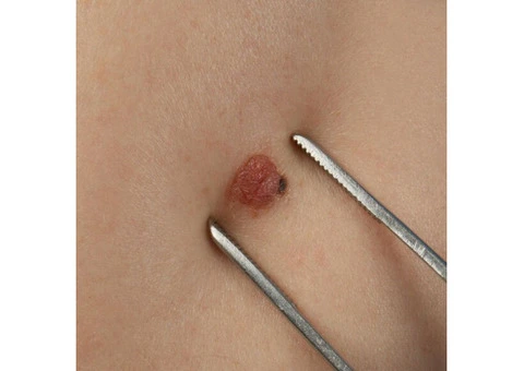 cyst removal cost