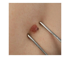 cyst removal cost