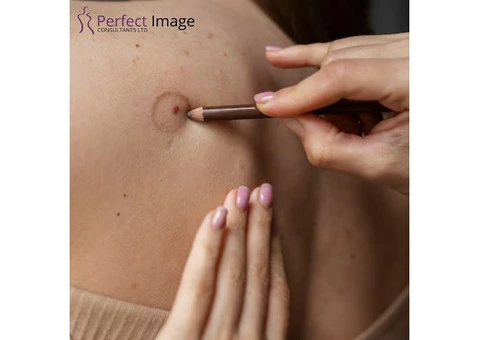 Sebaceous Wart Removal