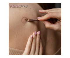 Sebaceous Wart Removal
