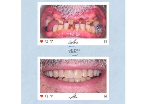 How Can Composite Teeth Bonding Improve Your Smile?