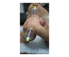 The Complete Hijama Cupping Practitioner’s Course