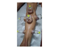 Explore Hijama: The Ancient Art of Cupping for Health