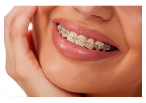 Invisible Braces in London – Achieve a Perfect Smile