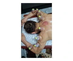 From Novice to Expert: A Hijama Cupping Training Journey