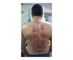 Cupping Therapy for Pain Relief: The Hijama Method