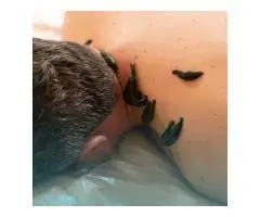 Leech Therapy for Skin and Blood Health: A Comprehensive Course