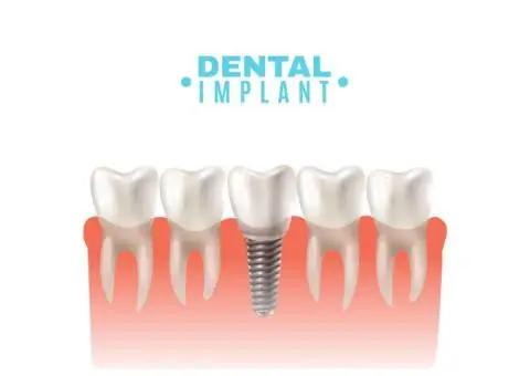 How Long Do Dental Implants Last? Expert Insights from South London Dentists!