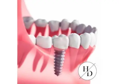 Are Cheap Dental Implants the Solution You’ve Been Searching for?