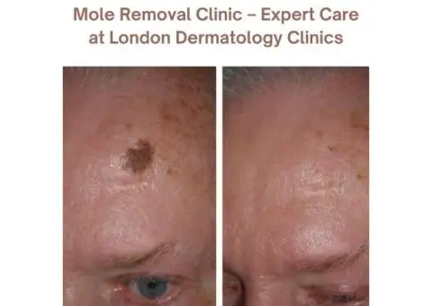 Private Mole Removal at London Dermatology Clinics – Safe & Professional Treatment