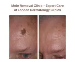 Private Mole Removal at London Dermatology Clinics – Safe & Professional Treatment
