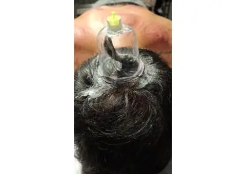 Advanced Hijama Training for Professionals - 2/2