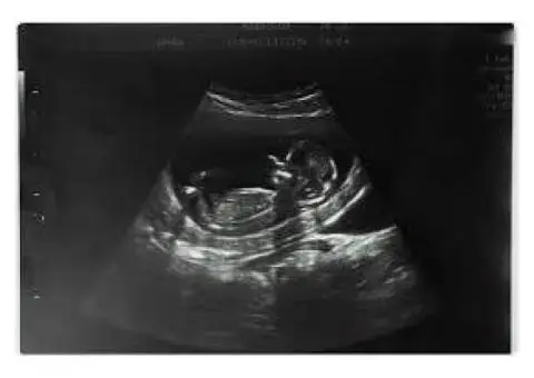 Early Pregnancy Check? Try Our Private Ultrasound Scan Watford