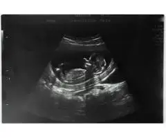 Early Pregnancy Check? Try Our Private Ultrasound Scan Watford