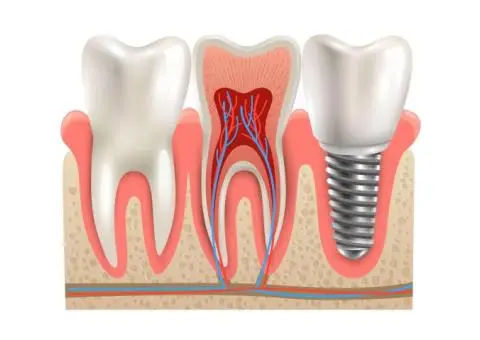 The Science Behind Dental Implants: Why They’re the Gold Standard for Tooth Replacement