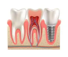 The Science Behind Dental Implants: Why They’re the Gold Standard for Tooth Replacement