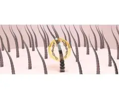 Stem Cell Hair Follicle Regeneration Treatment in London | Levitas Aesthetics