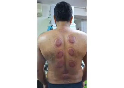Cupping Therapy Fundamentals: Learn the Hijama Method - 1/3